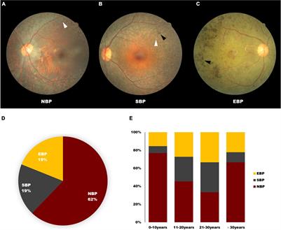 Global spectrum of USH2A mutation in inherited retinal dystrophies: Prompt message for development of base editing therapy